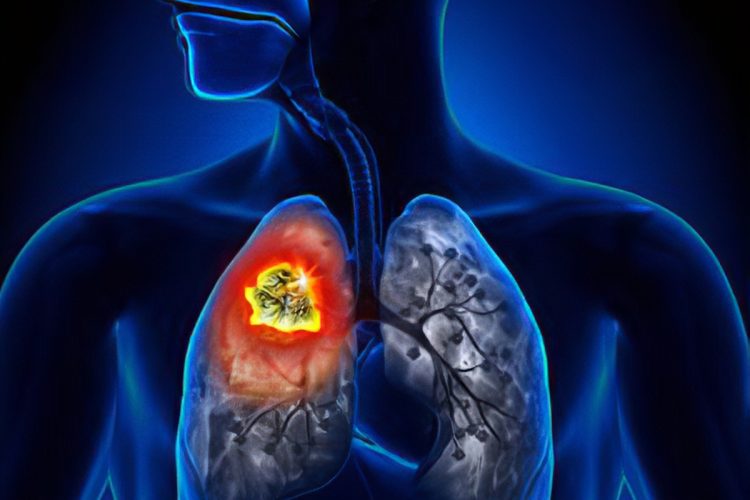 The Reason Behind The Increase In Lungs Cancer