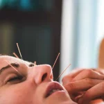 Exploring the Healing Potential of Acupuncture: Is It Right for You?
